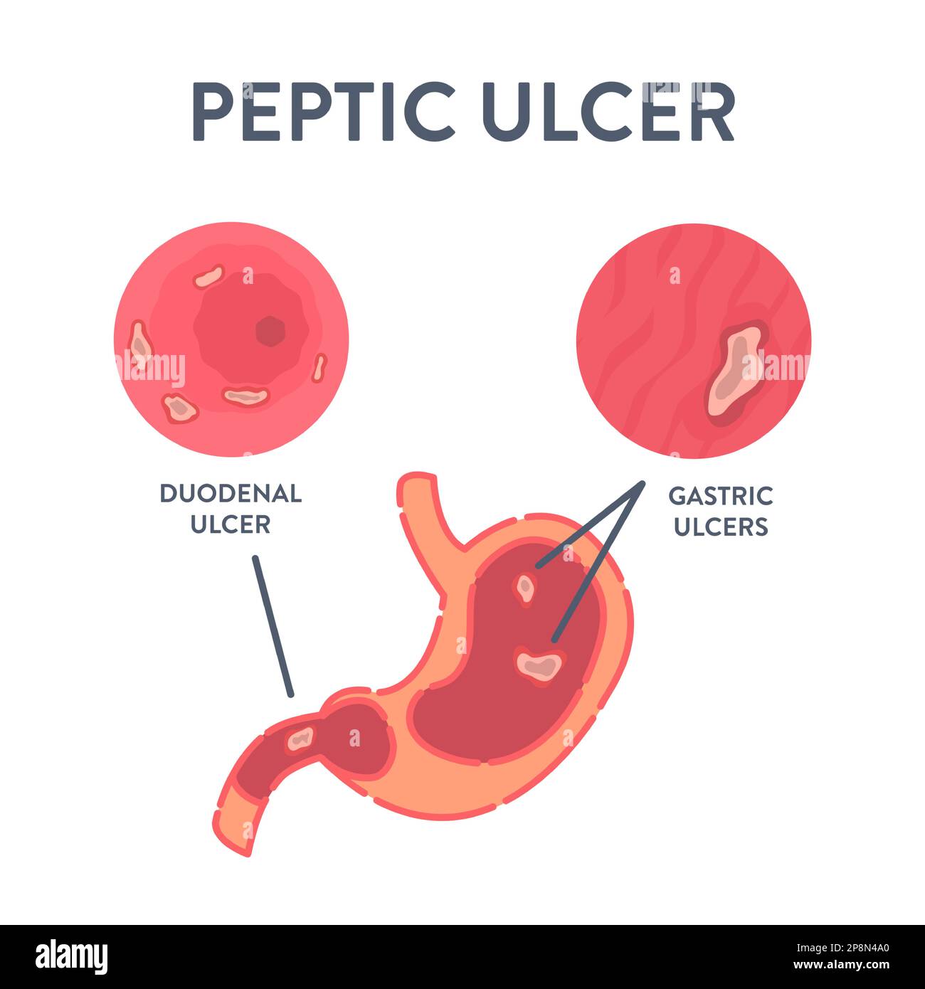 Stomach Peptic Ulcer Detected By Endoscopy Procedure Stock Vector Image Stomach Peptic Ulcer Detected By Endoscopy Procedure Stock Vector Image