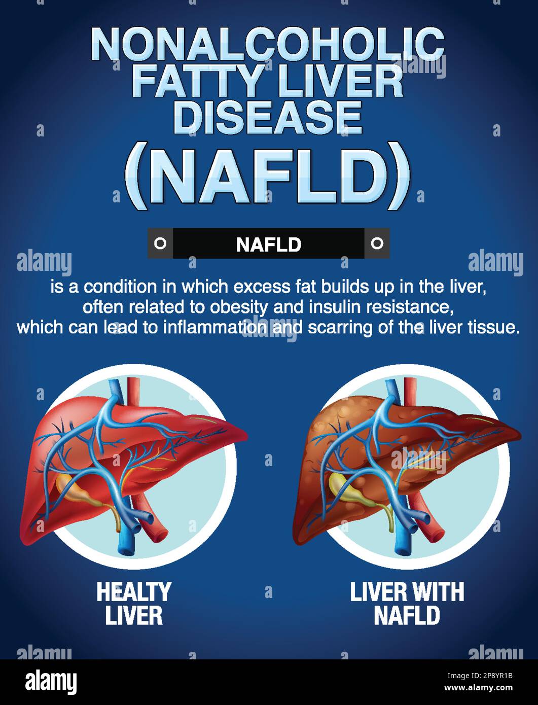 Nonalcoholic Fatty Liver Disease Illustration Stock Vector Image Art nonalcoholic-fatty-liver-disease-illustration-stock-vector-image-art