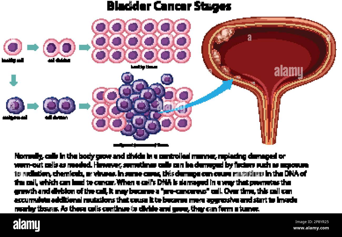 Informative Bladder Cancer Stages illustration Stock Vector