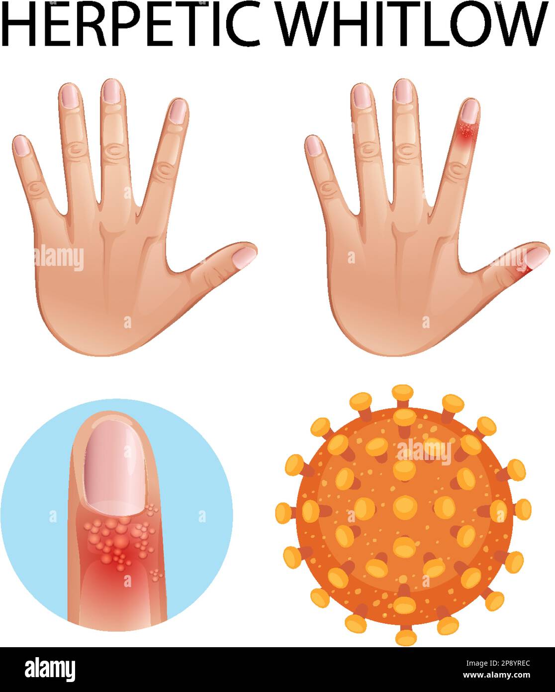 Human finger with herpetic whitlow skin disease illustration Stock