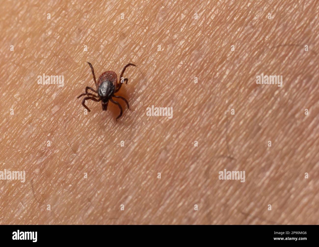 Infected female deer tick on hairy human skin. Ixodes ricinus. Parasitic mite. Acarus. Dangerous biting insect on background of epidermis detail. Disg Stock Photo