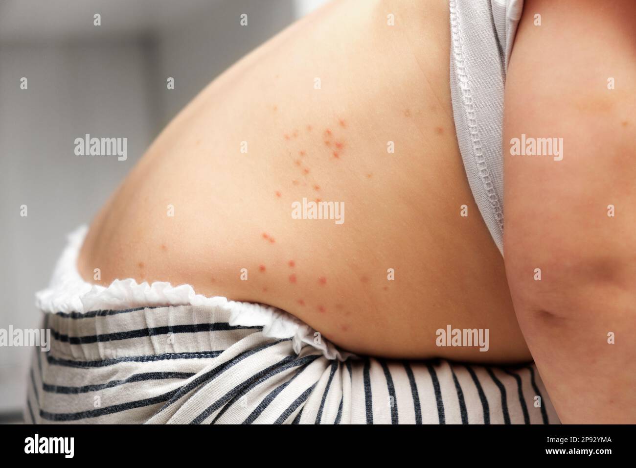 Back of Small Child with Red Rash. Baby with Red Spots Blisters on the ...