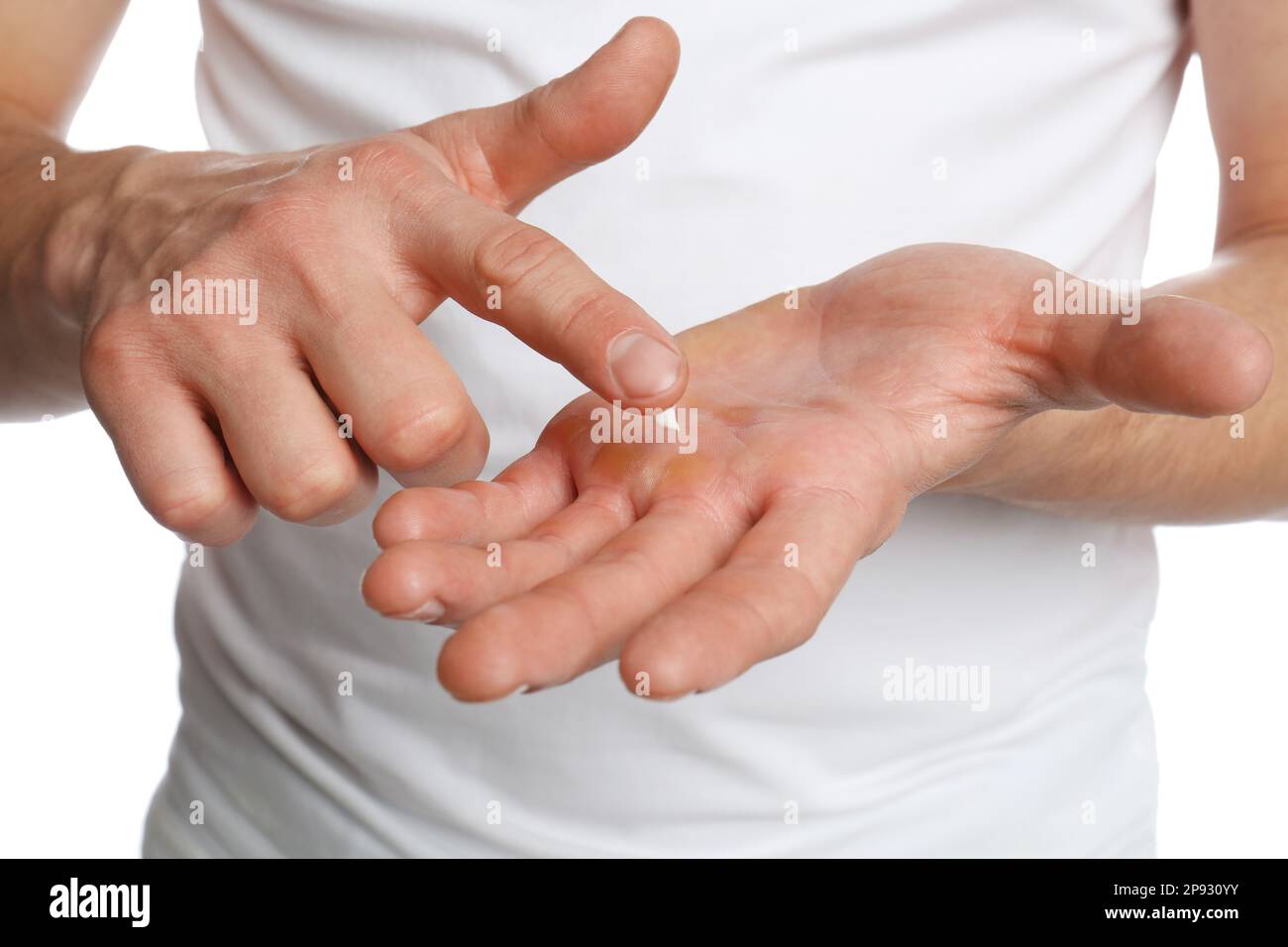 Man applying cream on hand for calluses treatment against white