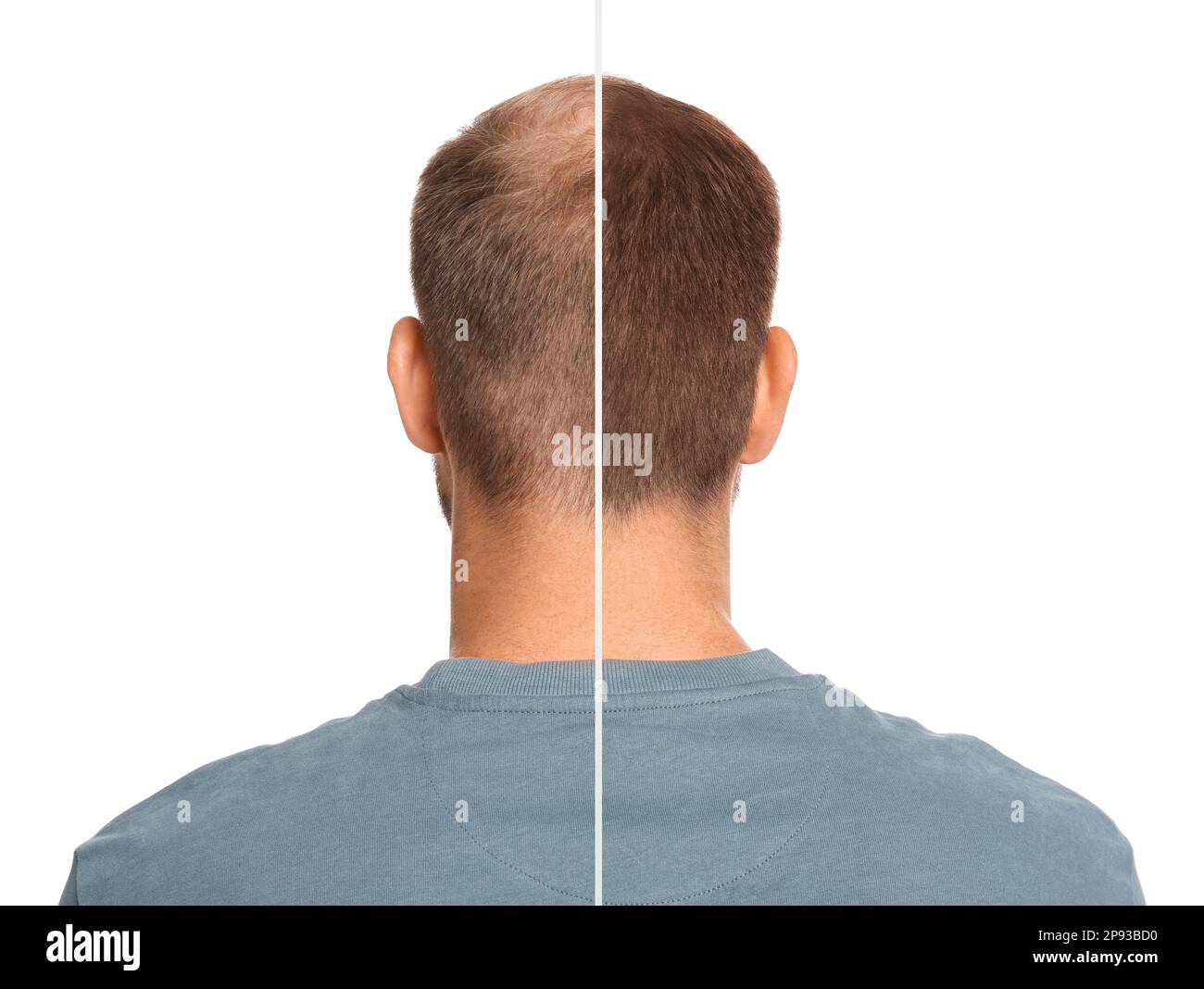 Man with hair loss problem before and after treatment on white