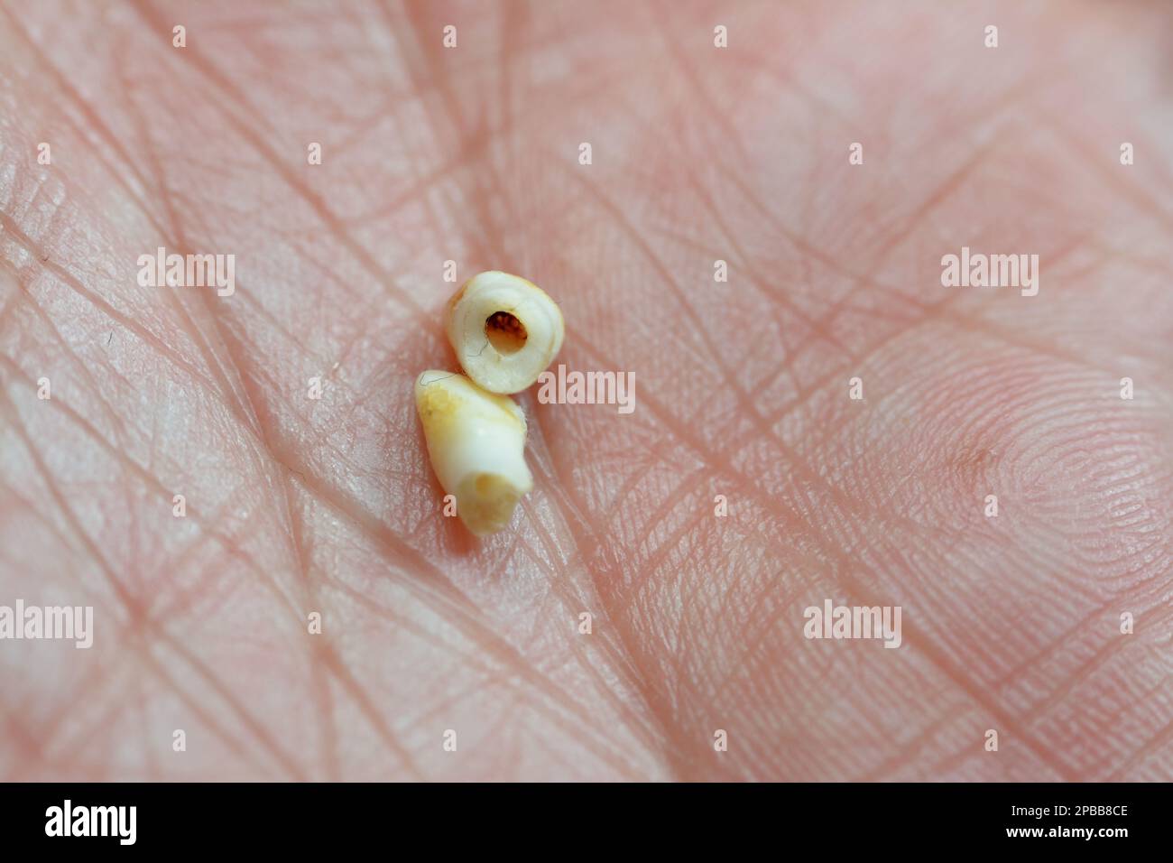 Deciduous primary baby temporary teeth, the first set of teeth in the