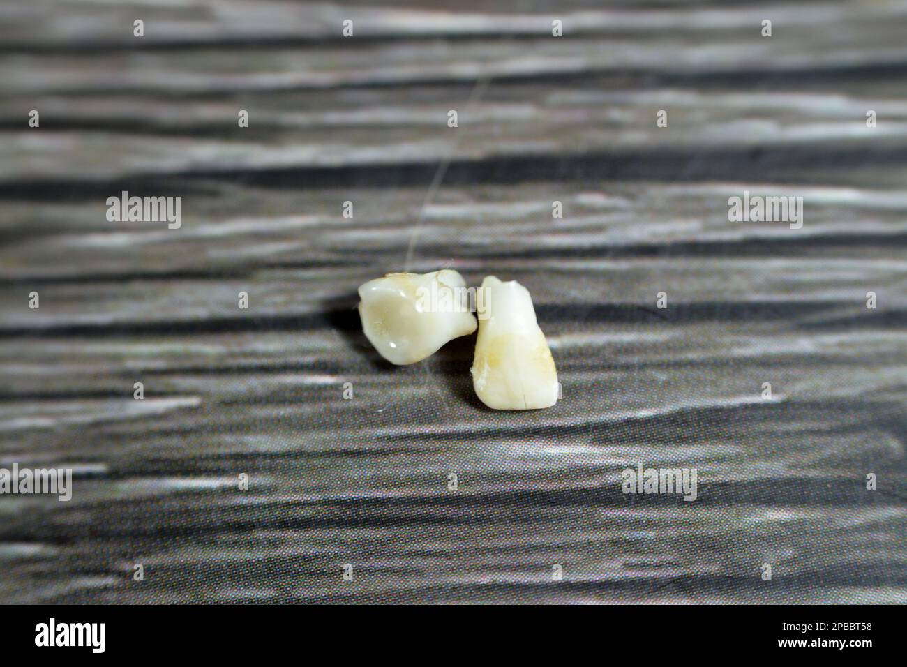 Deciduous primary baby temporary teeth, the first set of teeth in the