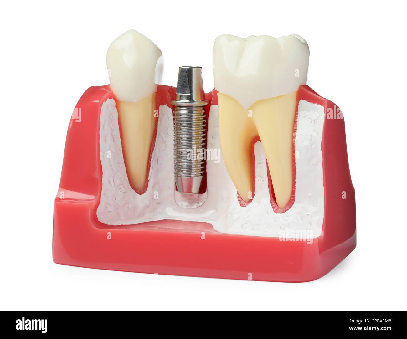 Educational model with post and abutment of dental implant between
