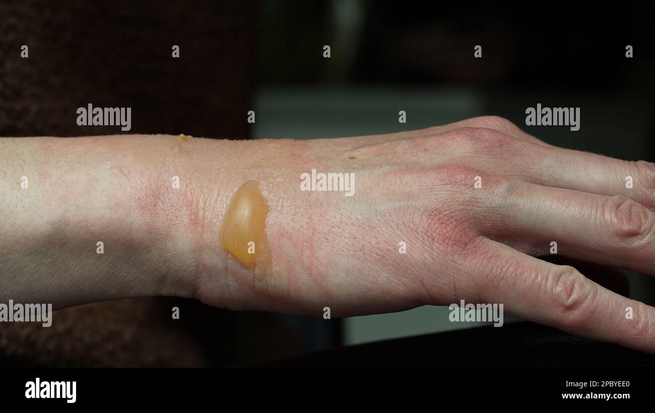 Closeup of a woman's hand with a blister from a boiled water burn