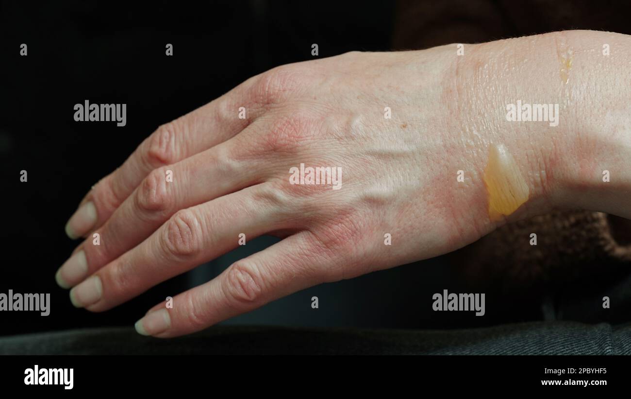 Closeup of a woman's hand with a blister from a boiled water burn