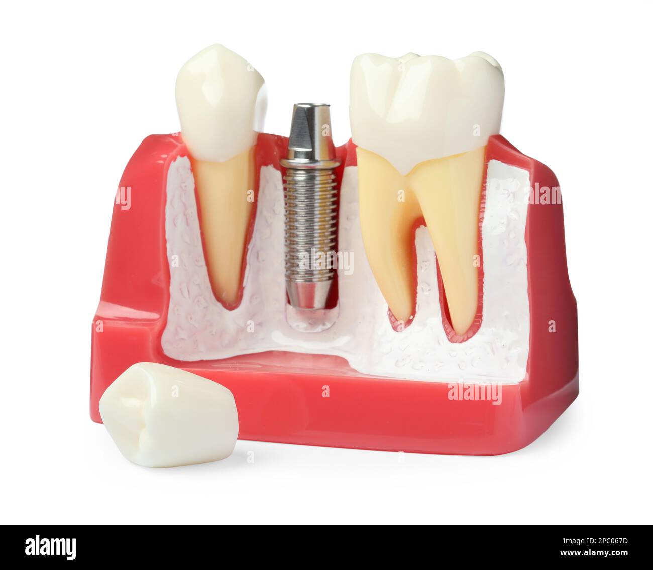 Educational model with post and abutment of dental implant between