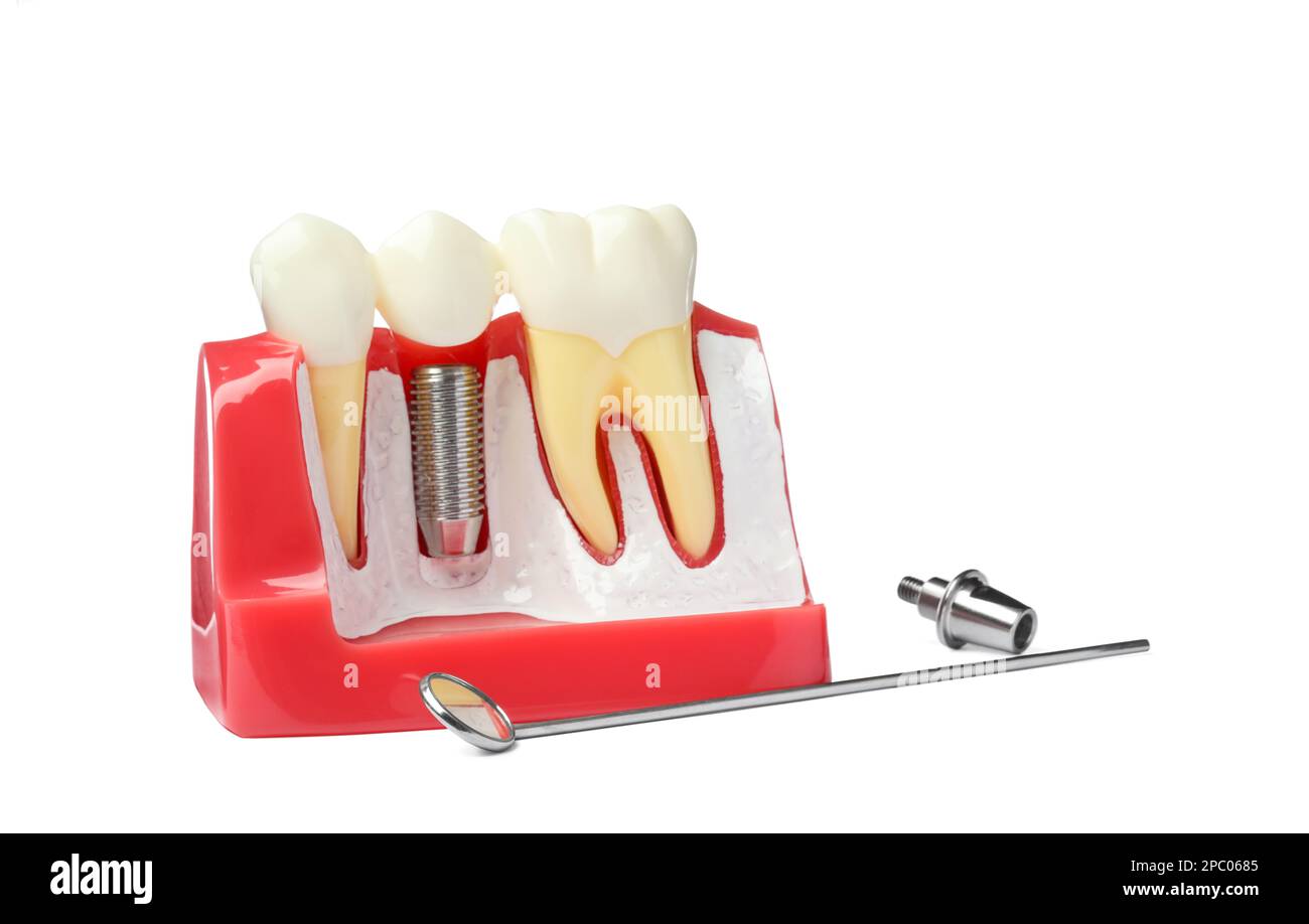 Educational model with post and crown of dental implant between teeth
