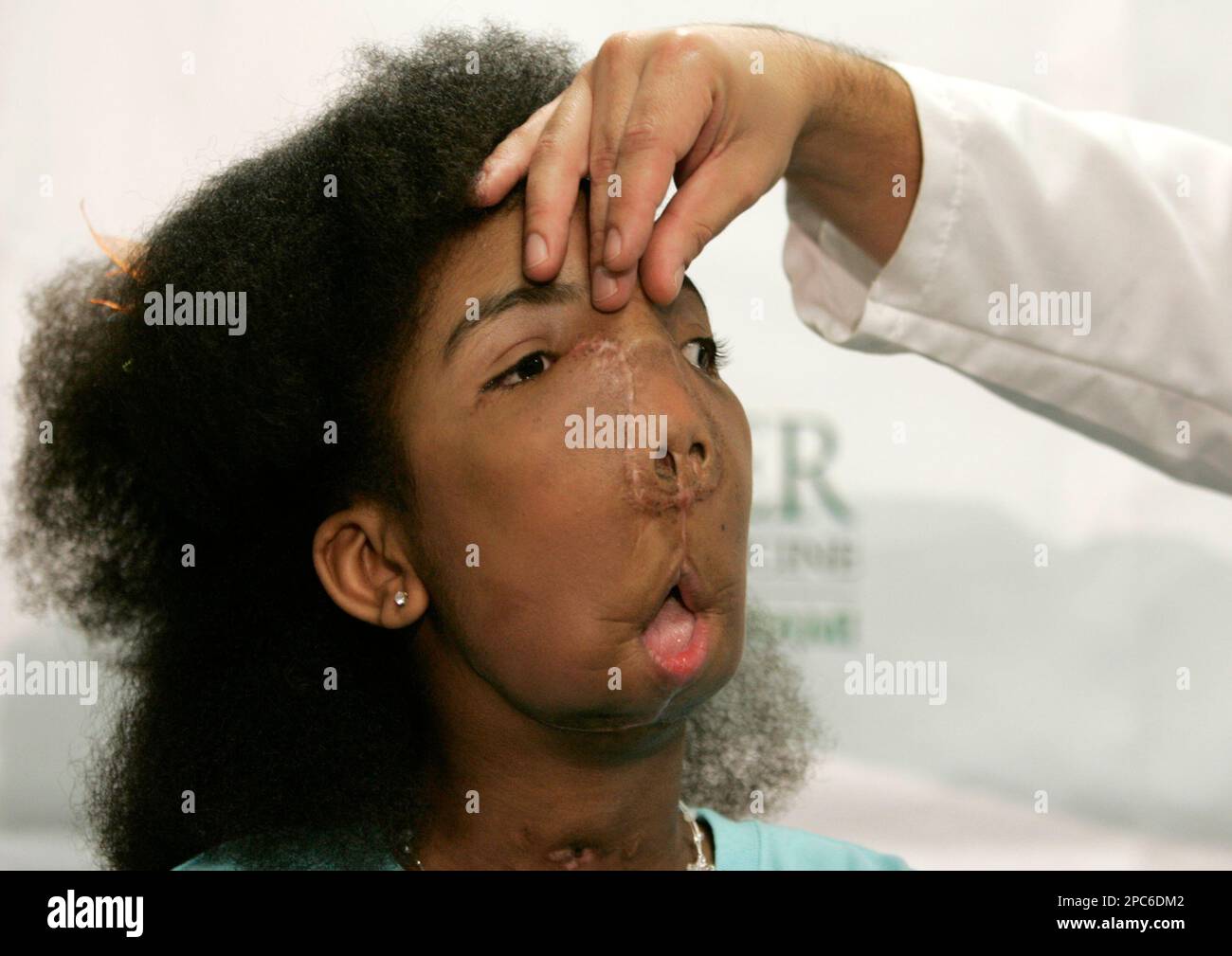 Marlie Casseus stands as Dr. Jesus Gomez touches her face while talking  about her most recent surgery during a news conference at Jackson Memorial  Hospital in Miami, Tuesday, Dec. 19, 2006. Marlie