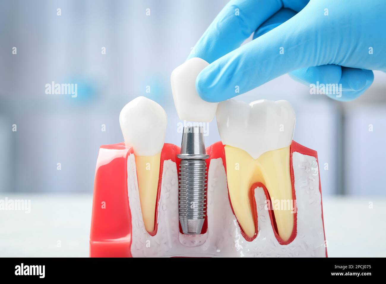 Dentist putting crown onto abutment of dental implant between teeth on