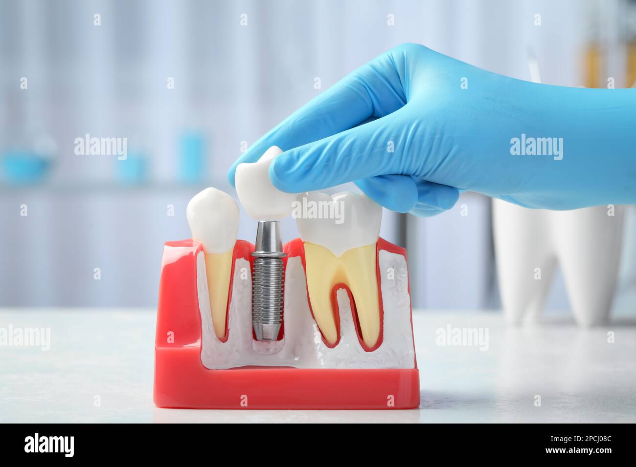 Dentist putting crown onto abutment of dental implant between teeth at