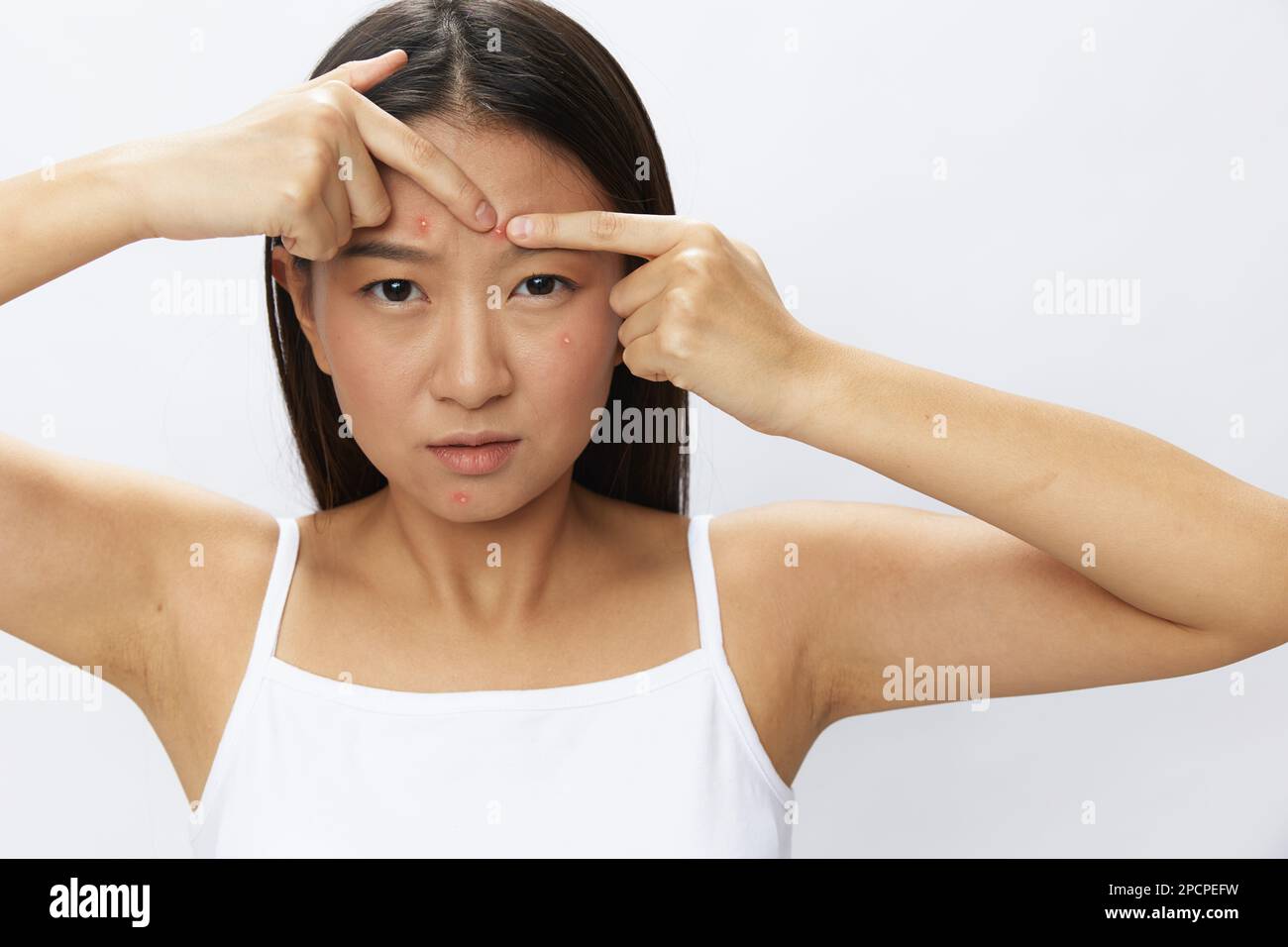 Asian woman facial skin problems, acne and inflammation, red rashes and