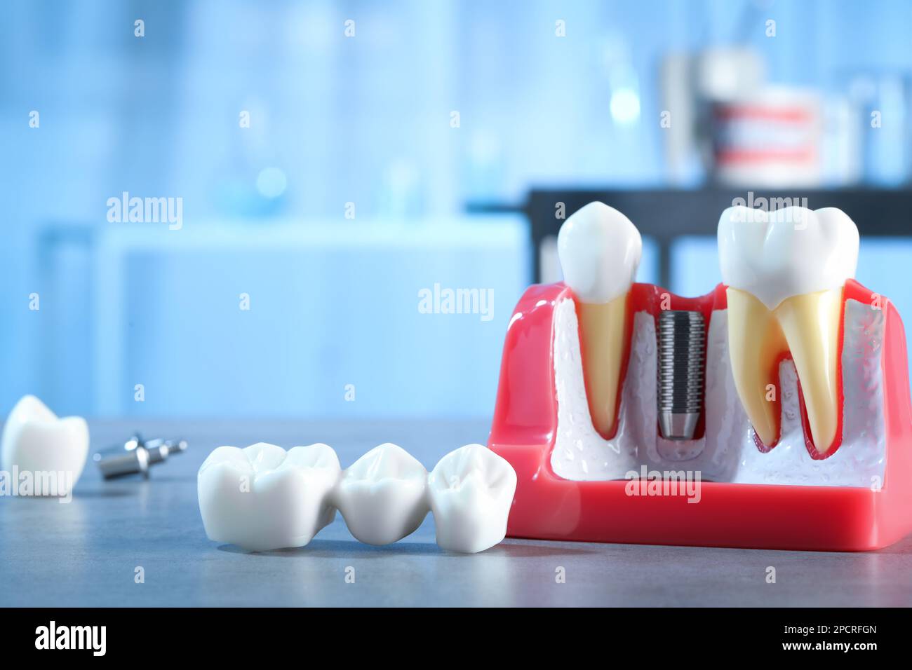 Educational model with post of dental implant between teeth and crowns