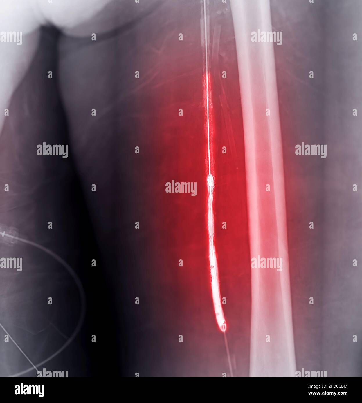 Image of Angioplasty, balloon angioplasty and percutaneous transluminal