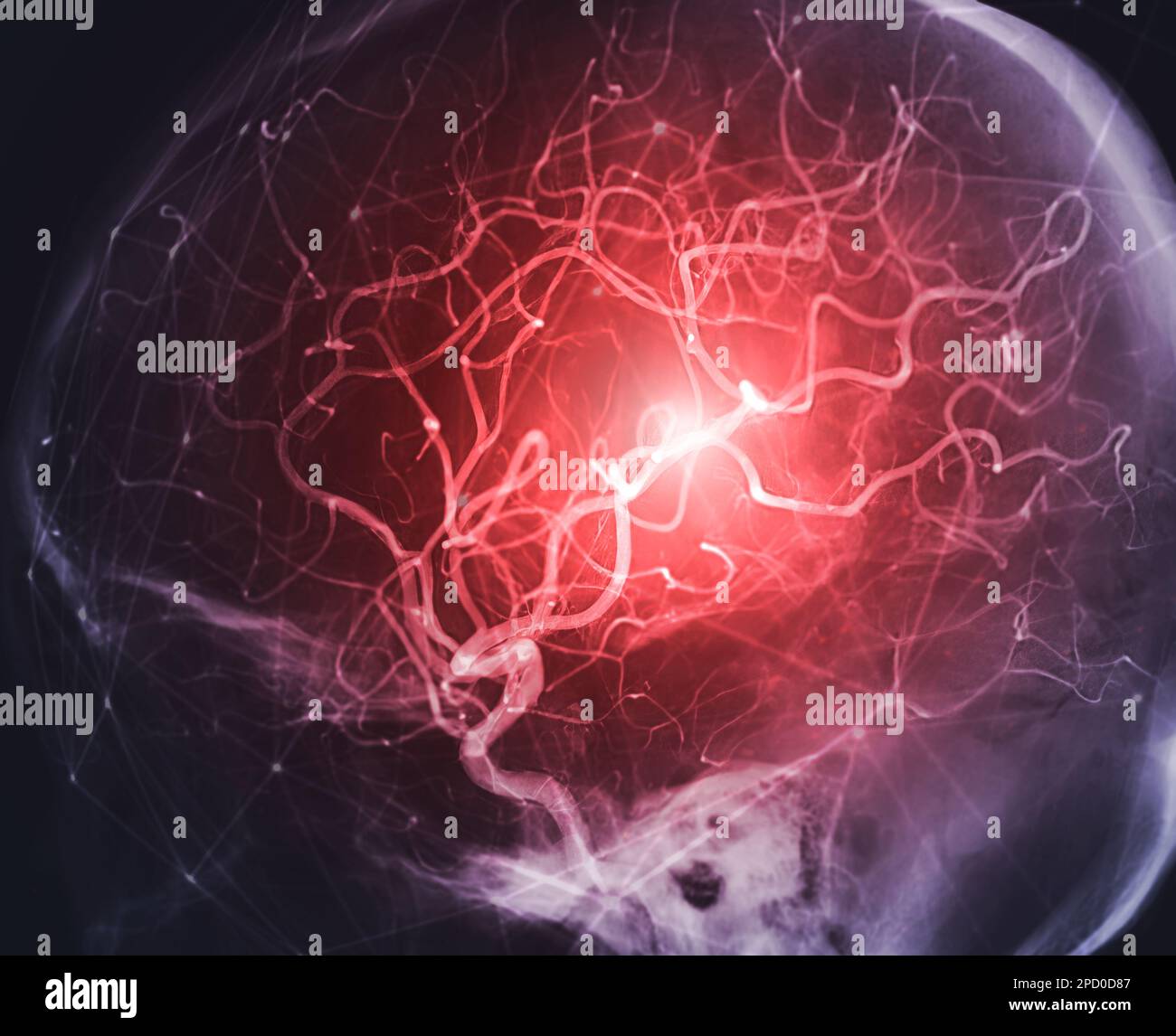Cerebral angiography image from Fluoroscopy in intervention radiology