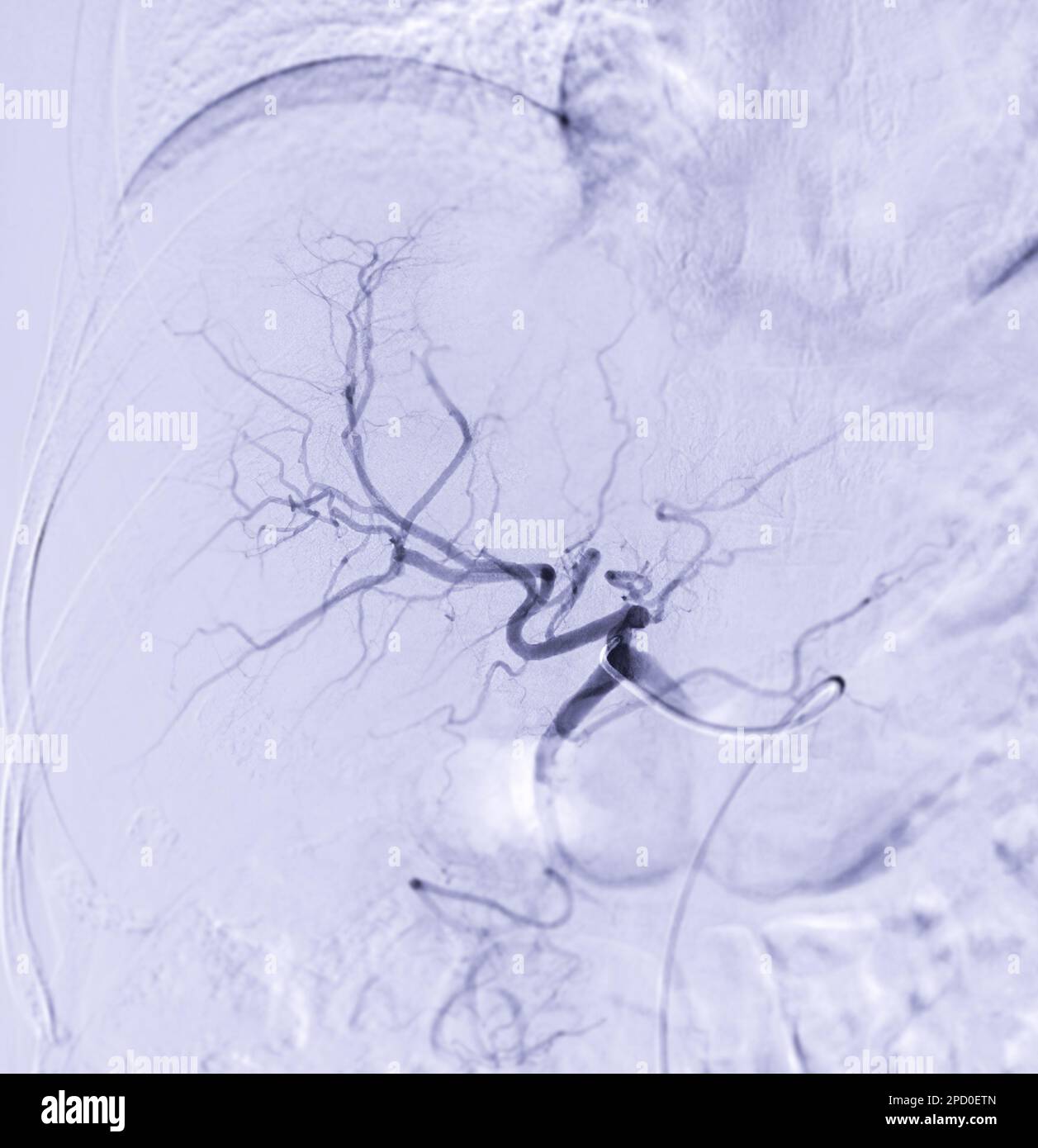 Imaging of TACE or Chemoembolization is a procedure that allows a dose of chemotherapy drugs to be administered directly to Liver tumor or HCC showing Stock Photo