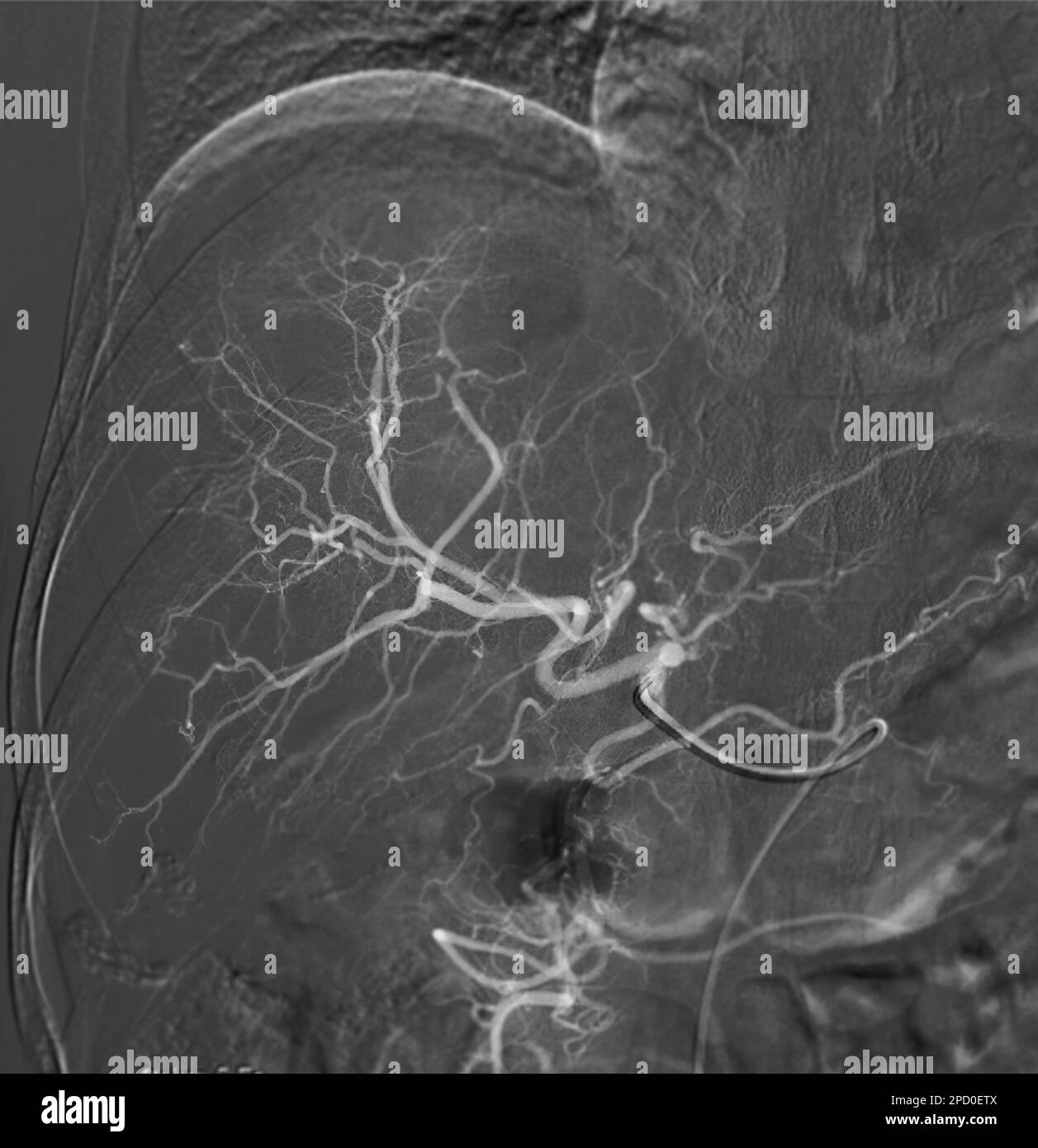 Imaging of TACE or Chemoembolization is a procedure that allows a dose of chemotherapy drugs to be administered directly to Liver tumor or HCC showing Stock Photo