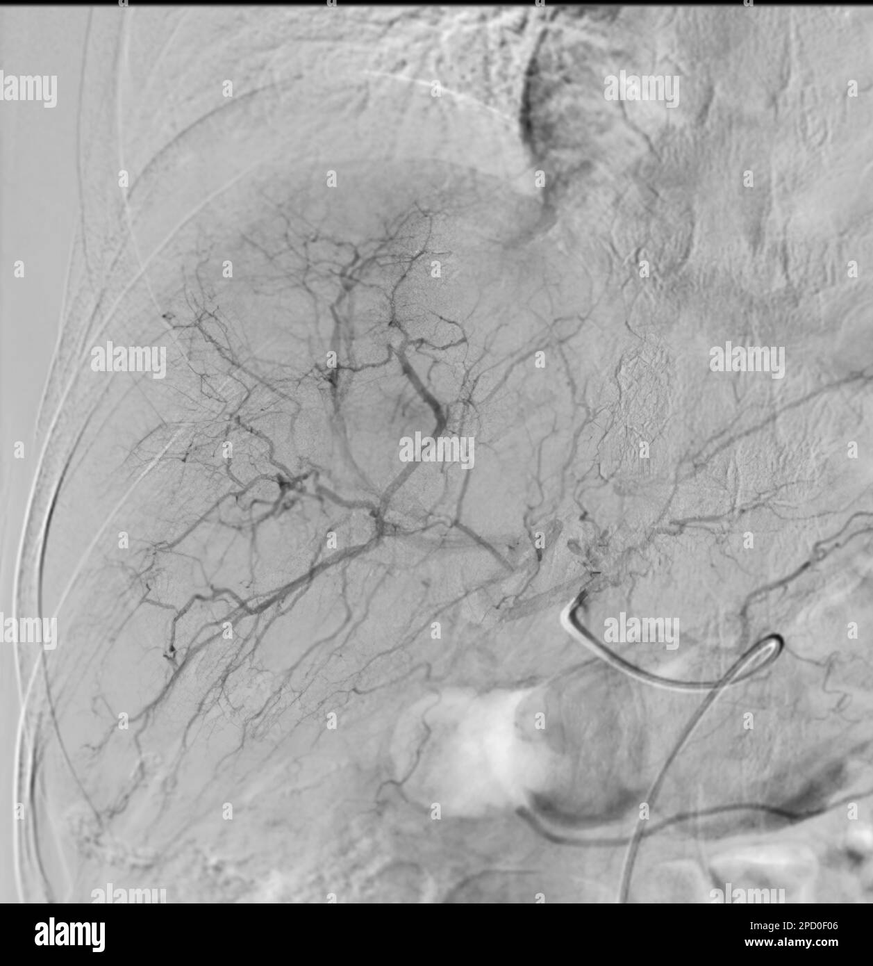 Imaging of TACE or Chemoembolization is a procedure that allows a dose of chemotherapy drugs to be administered directly to Liver tumor or HCC showing Stock Photo