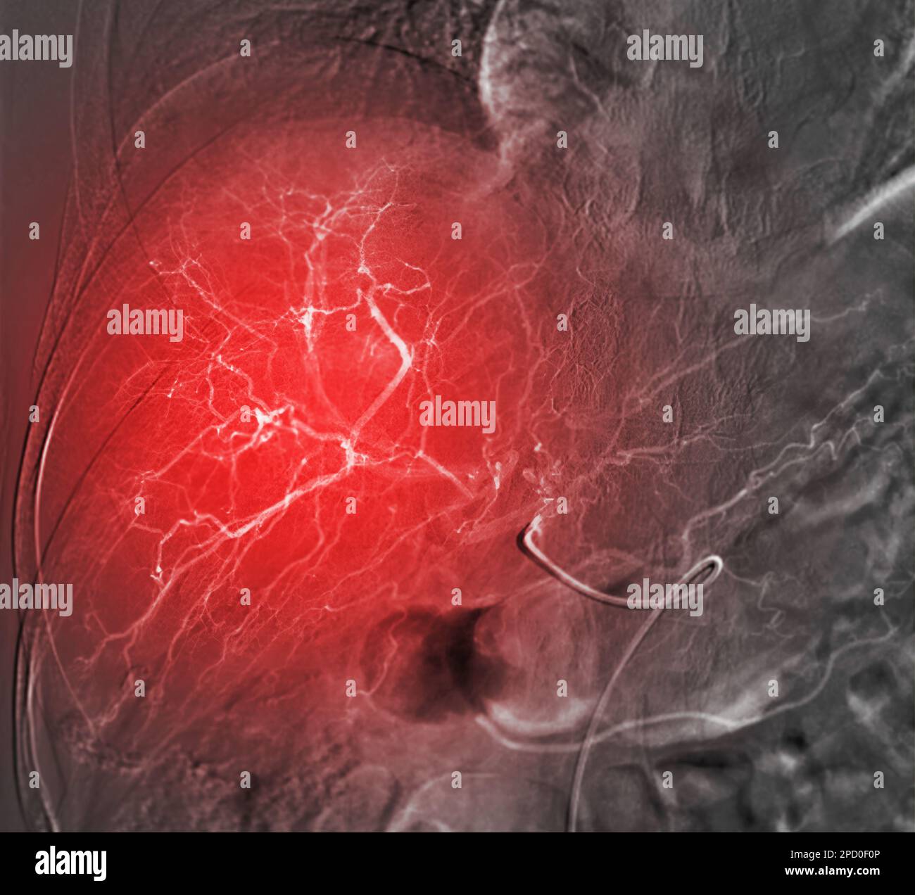 Imaging of TACE or Chemoembolization is a procedure that allows a dose of chemotherapy drugs to be administered directly to Liver tumor or HCC showing Stock Photo
