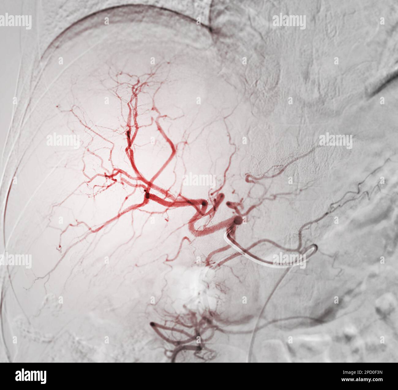 Imaging of TACE or Chemoembolization is a procedure that allows a dose of chemotherapy drugs to be administered directly to Liver tumor or HCC showing Stock Photo