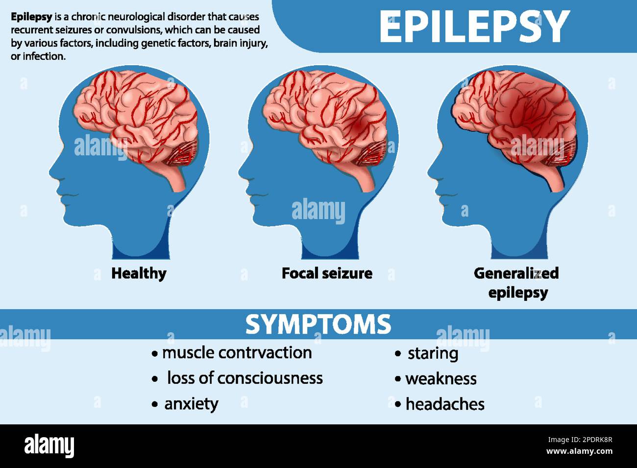 Informative poster of Epilepsy illustration Stock Vector Image & Art