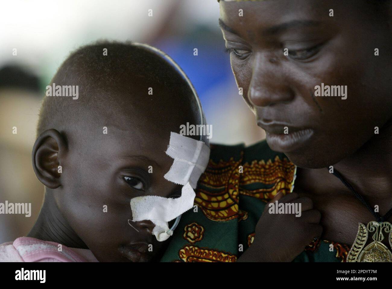 Malnourished 24 month old Magama Gambo of Nigerian origin is
