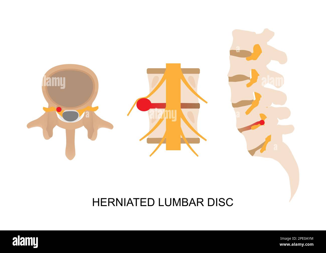 Illustration of herniated lumbar disc in different view. Stock Vector