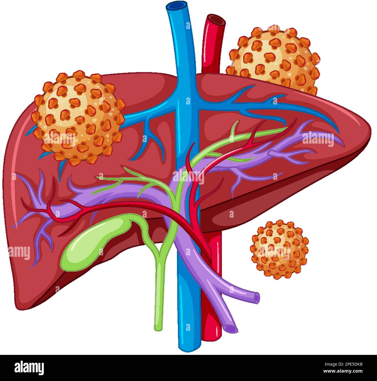 Hepatitis B liver infection virus illustration Stock Vector Image & Art Alamy