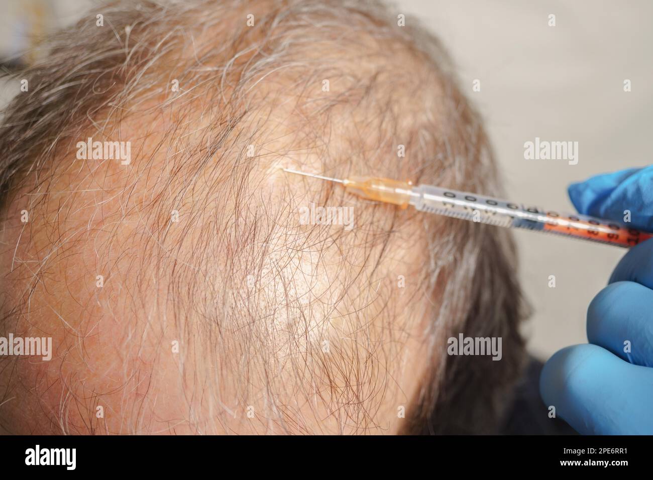 Hair transplantation, hair follicle transplantation, treatment of baldness and strengthening the scalp Stock Photo