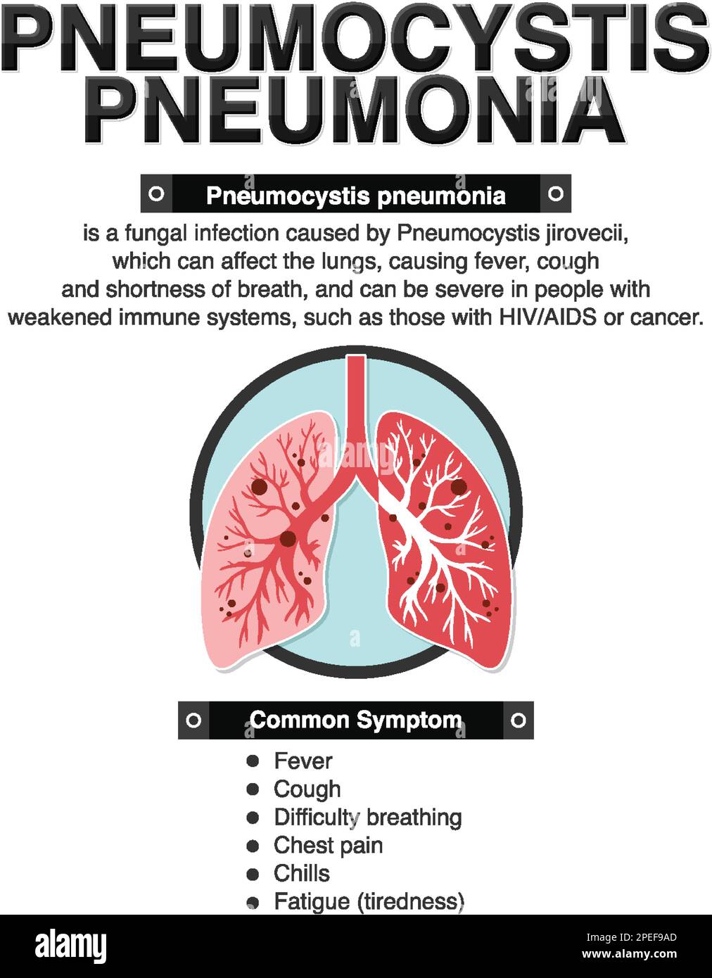 Informative poster of Pneumocystis Pneumonia illustration Stock Vector ...