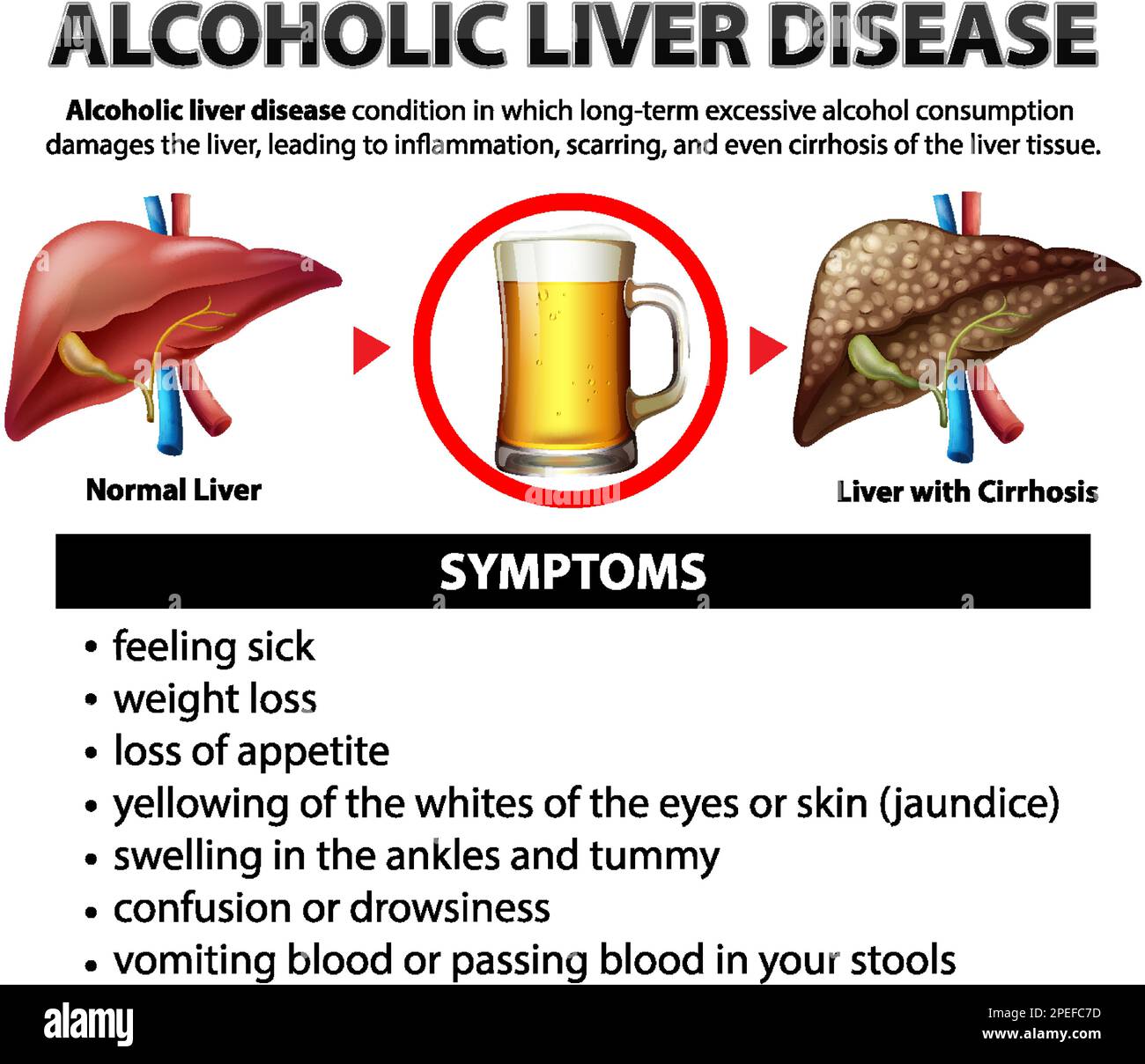 Informative poster of alcoholic liver disease Cirrhosis illustration Stock Vector Image & Art