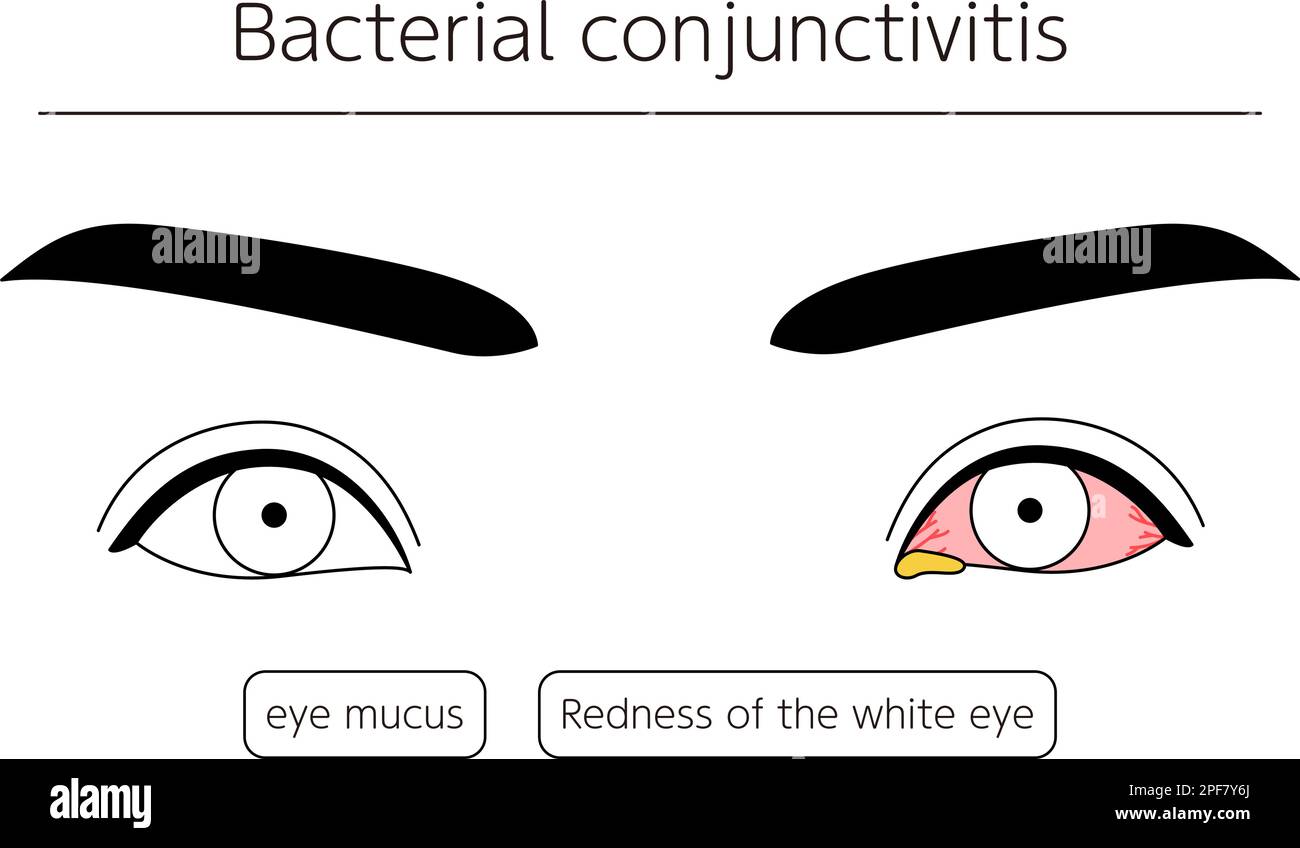 Medical Clipart, Line Drawing Illustration of Eye Disease and Bacterial conjunctivitis, Vector Illustration Stock Vector