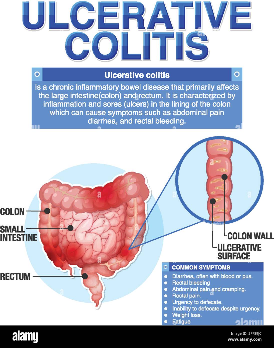 Ulcerative Colitis Symptoms Infographic illustration Stock Vector