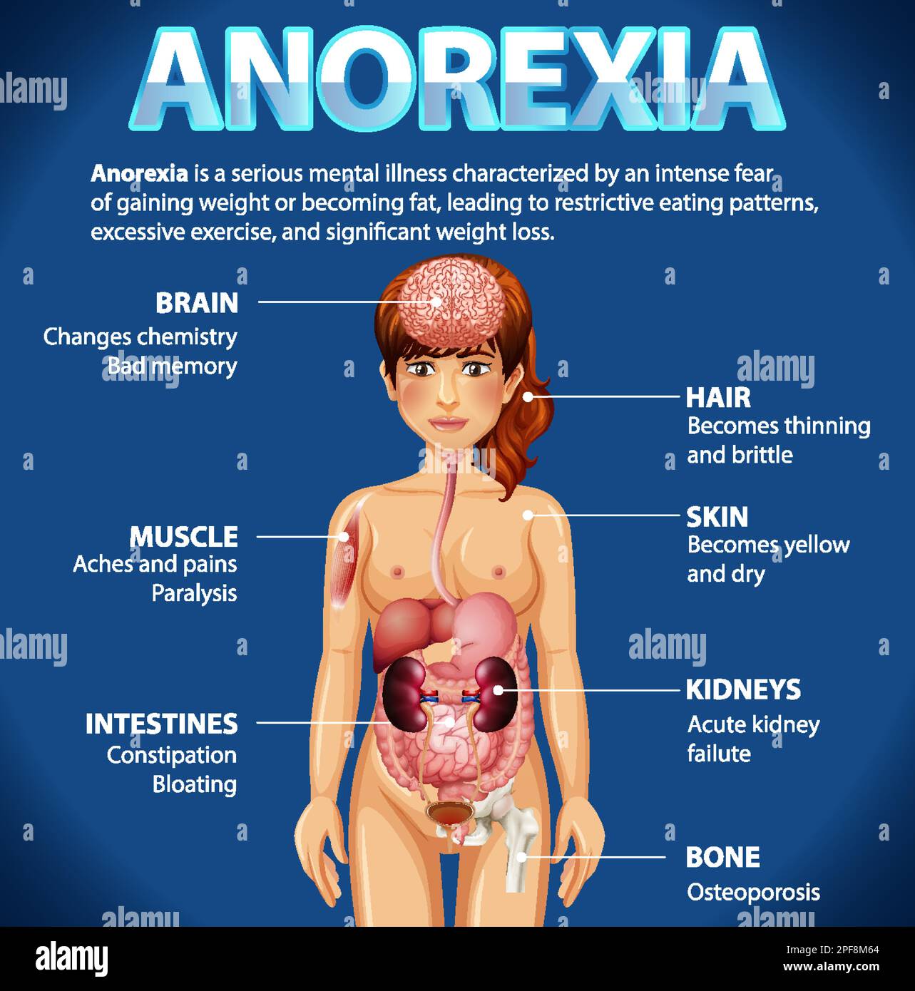 Informative poster of Anorexia eating disorder illustration Stock Vector  Image & Art - Alamy