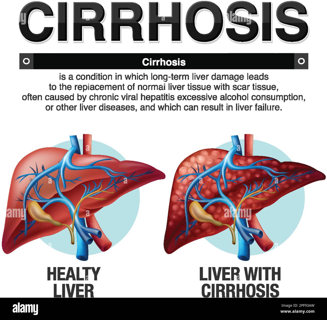 Cirrhosis of the Liver Infographic illustration Stock Vector