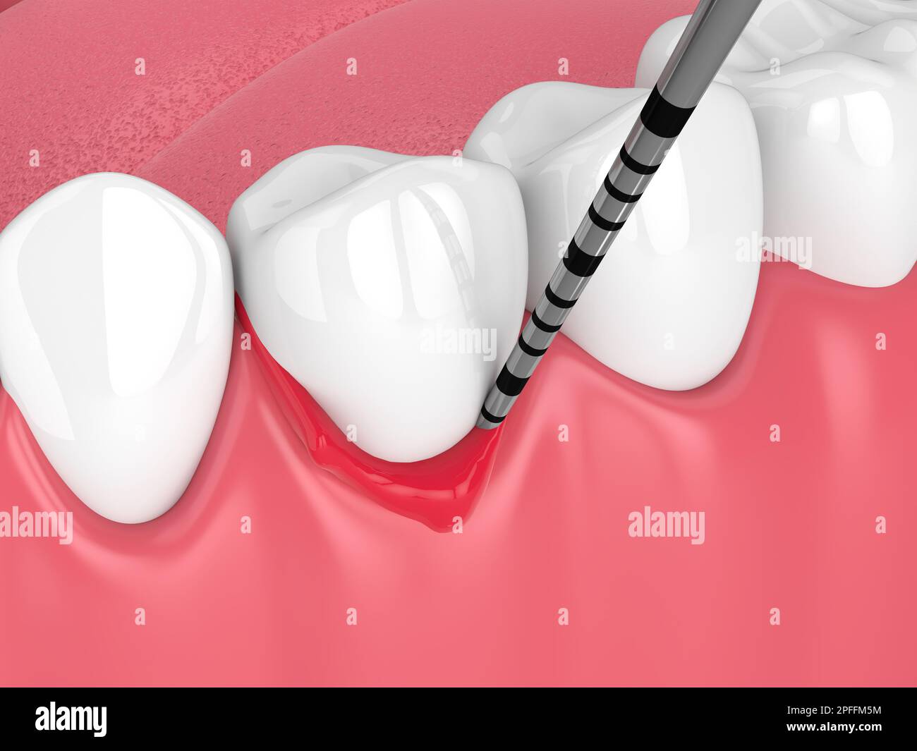 3d render of human jaw with peri implantitis disease and periodontal