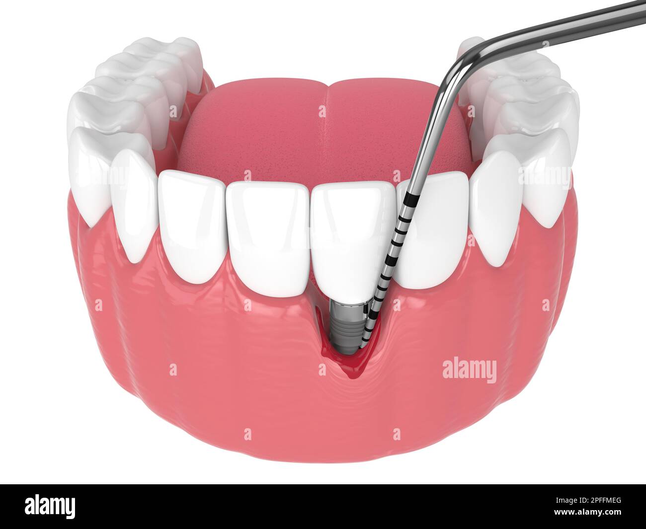 3d render of human jaw with peri implantitis disease and periodontal