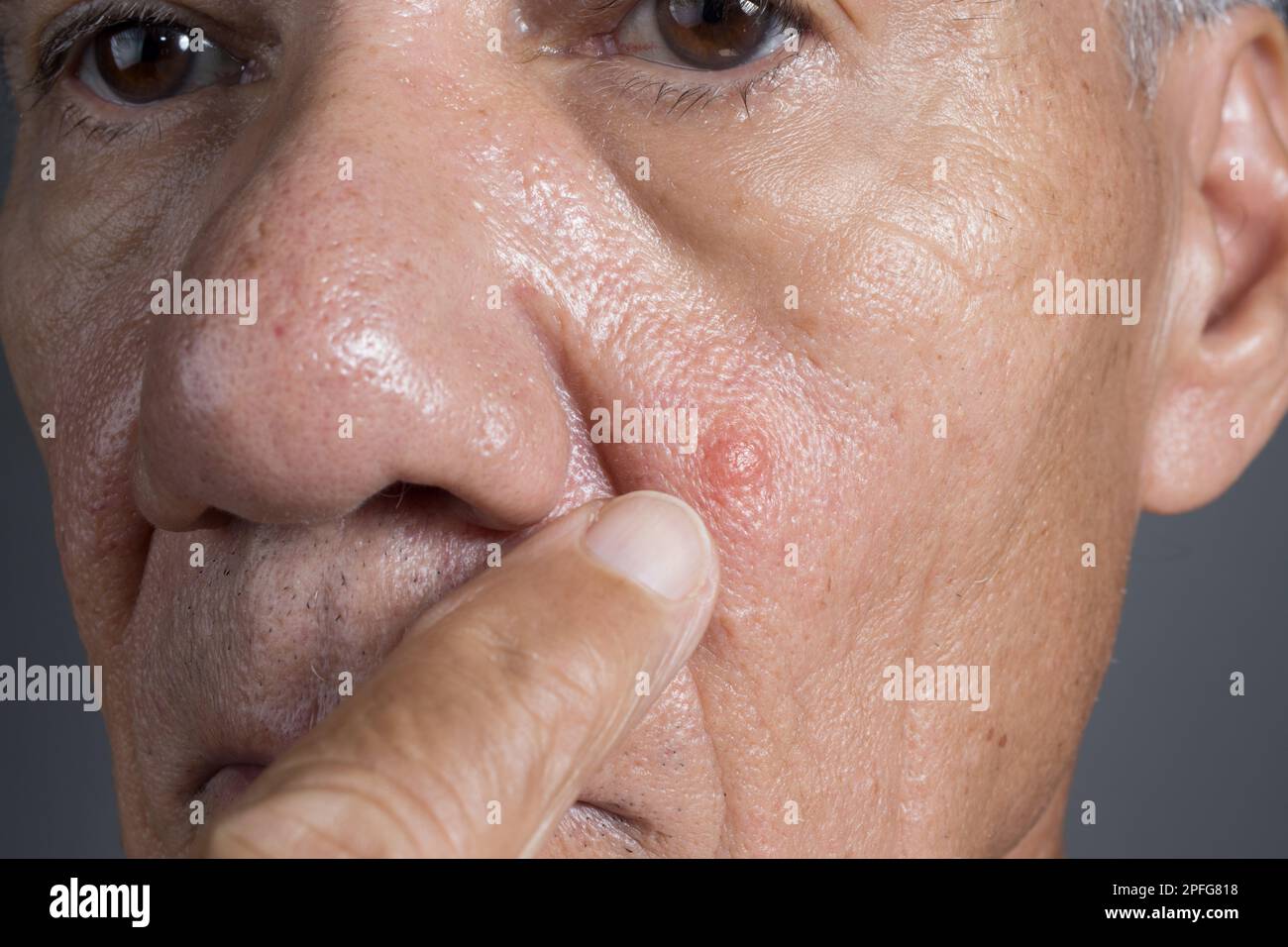 Close up of a Man with a big ugly pimple on his cheek Stock Photo - Alamy