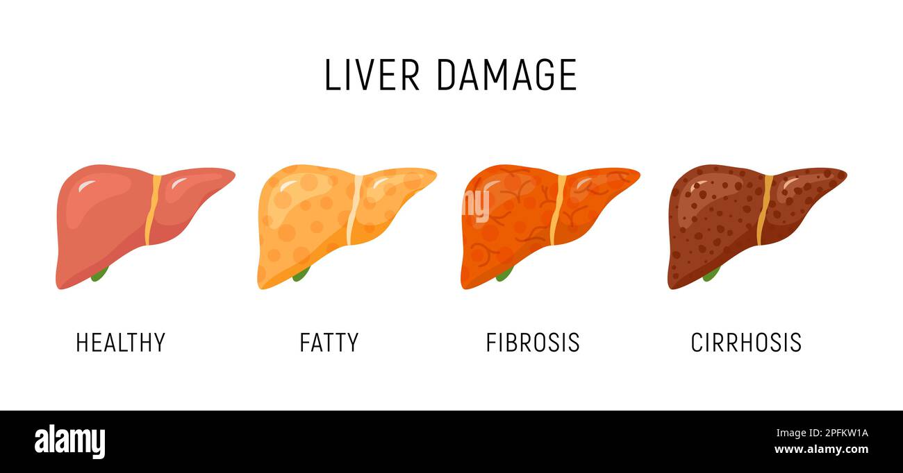 Liver damage infographic diagram cancer disease anatomy. Liver damage organ tissue hepatic carcinoma fibrosis stages. Stock Vector