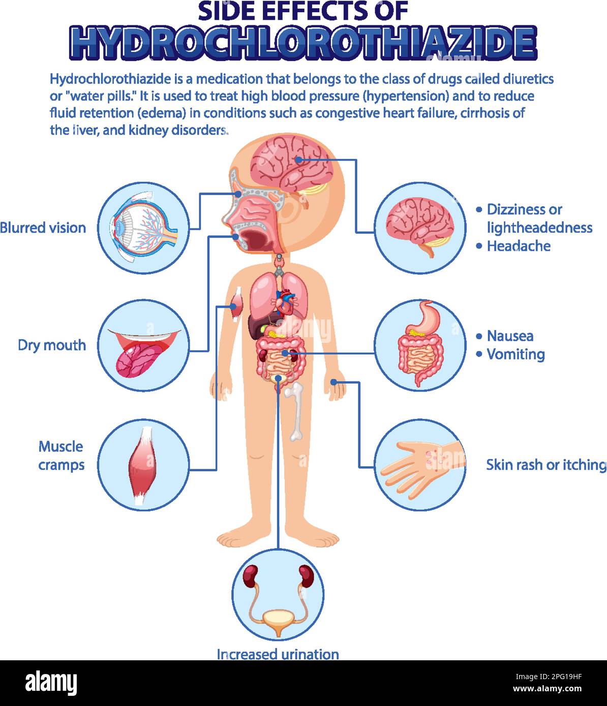 Human anatomy diagram cartoon style of hydrochlorothiazide side effects