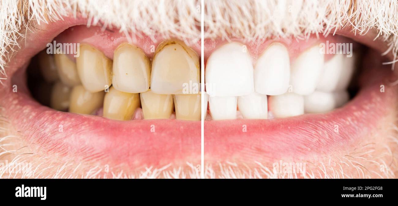 Male teeth before and after whitening, oral care dentistry, stomatology