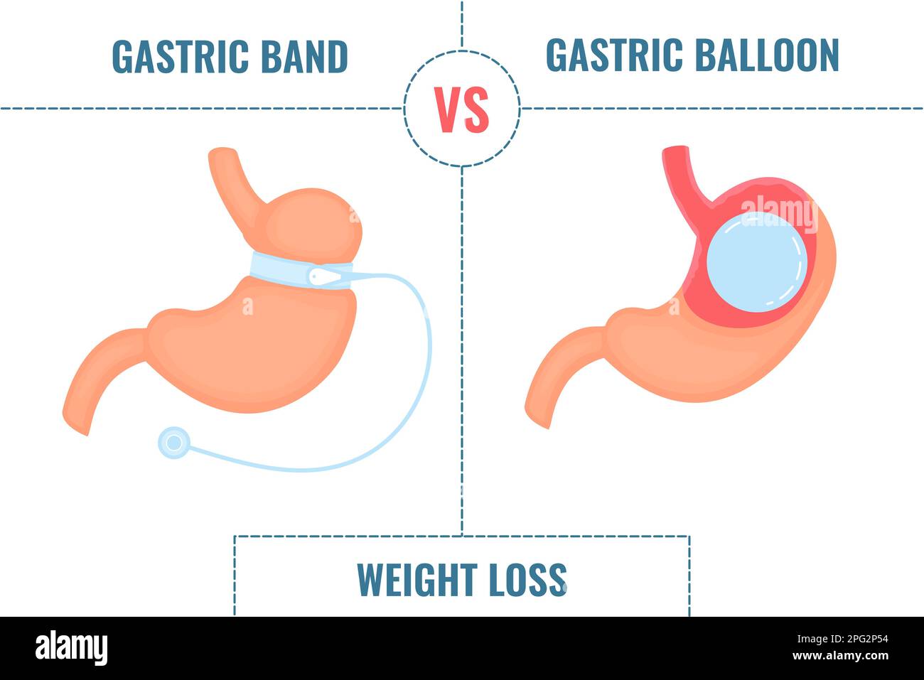 Gastric band vs gastric balloon bariatric surgery weight loss infographics Stock Vector