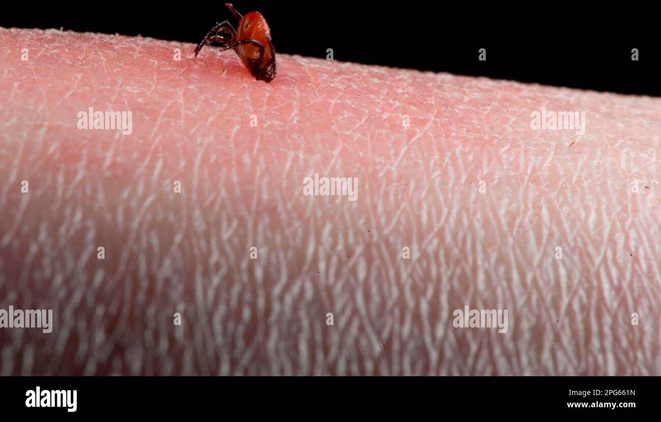 Tick (Acarina sp.) adult, feeding, on human skin with inflammation, England, United Kingdom Stock Photo