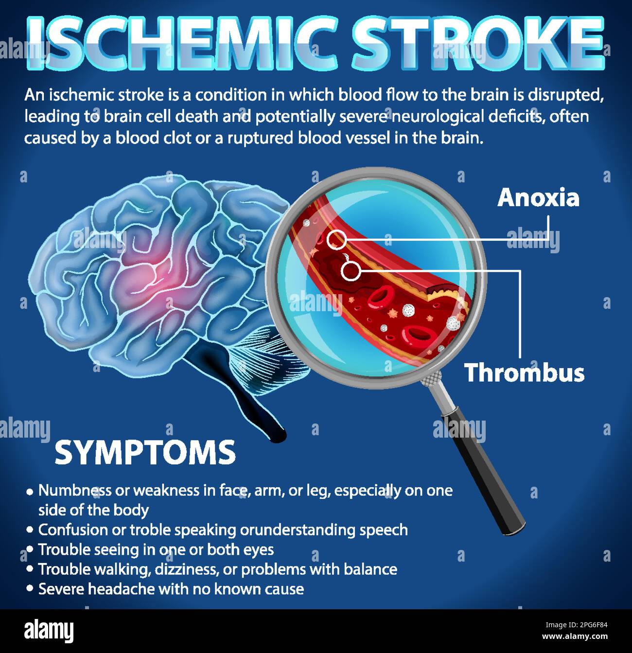 Informative poster of Ischemic stroke illustration Stock Vector Image ...