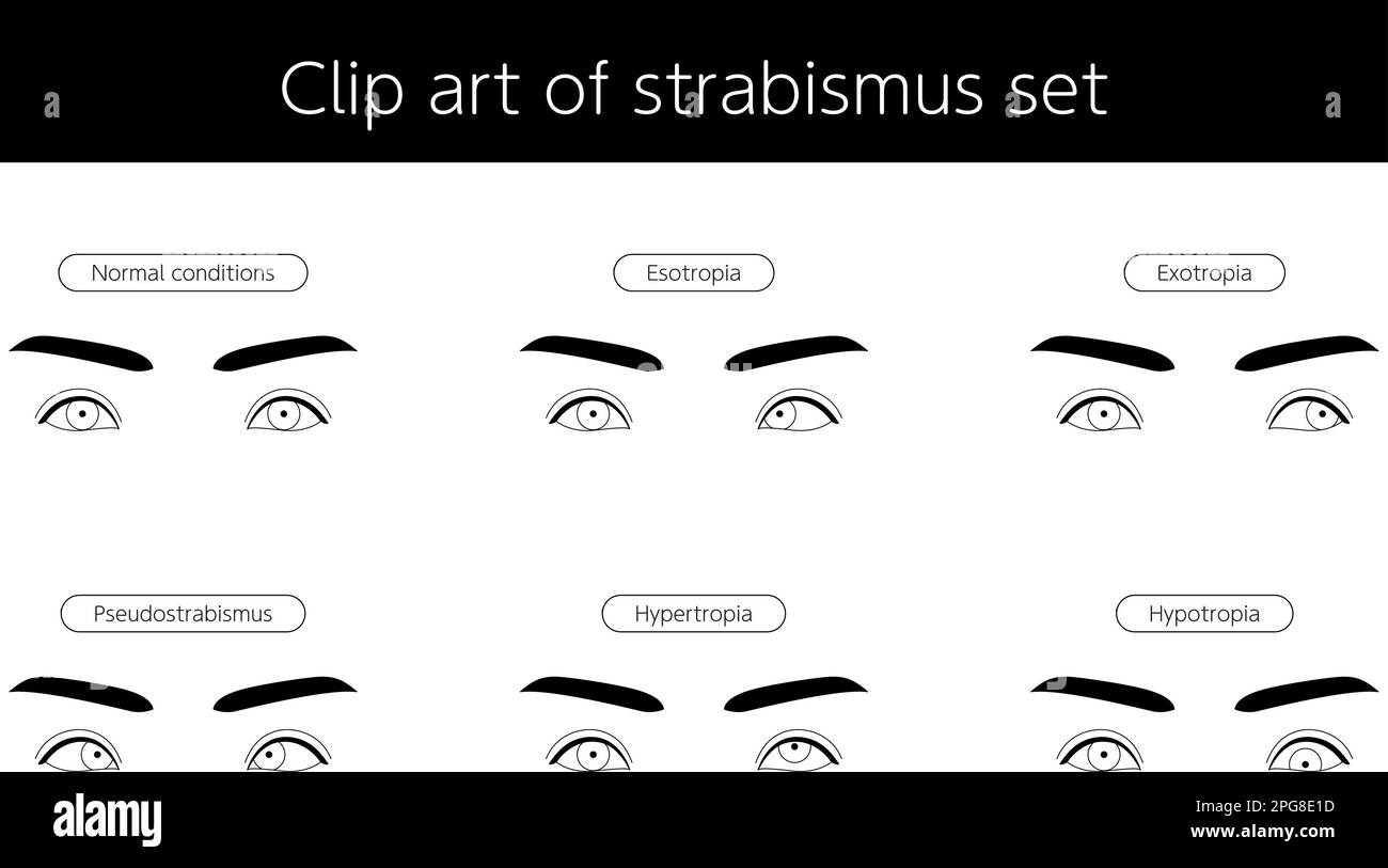 Medical illustration, Illustrative set eye diseases and strabismus, Vector Illustration Stock Vector