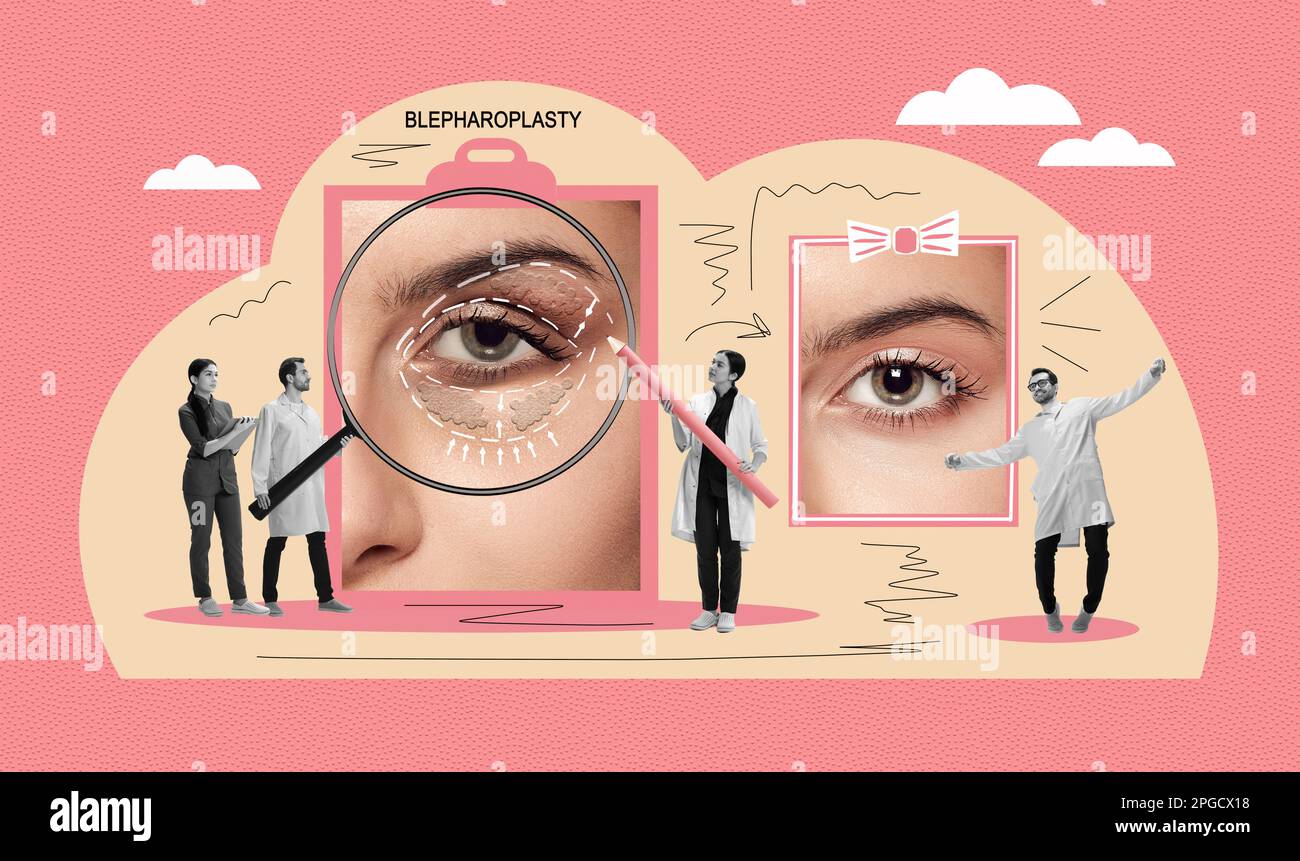 Lower blepharoplasty of eyelid, before and after. Plastic eyelid