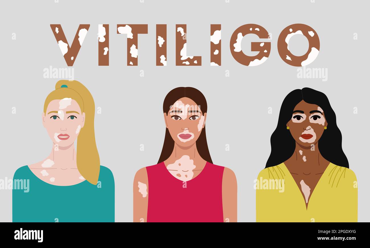 Set of female faces with vitiligo. World Vitiligo Day poster ...